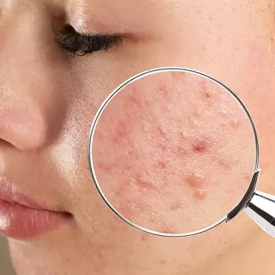 CLEARING THE WAY WHEN TO SEEK A DERMATOLOGIST FOR ACNE TREATMENT IN LAHORE