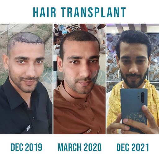 UNLOCKING THE SECRETS OF HAIR TRANSPLANTS IN LAHORE YOUR MUST-ASK QUESTIONS ANSWERED